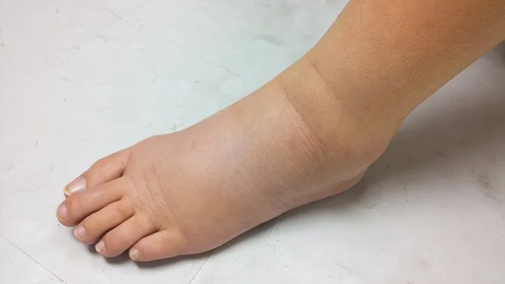 Understanding Edema: Causes, Symptoms, and Management Strategies